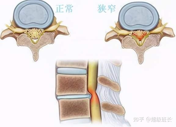 腰椎管狹窄手術(shù)成功率高嗎？都是怎樣做的？