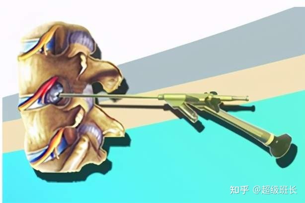 腰椎管狹窄手術(shù)成功率高嗎？都是怎樣做的？