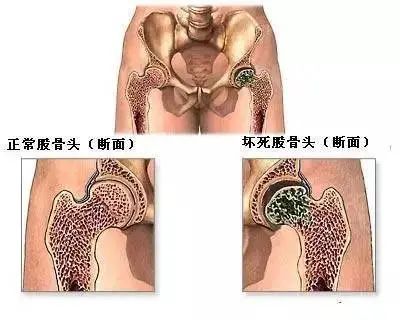 股骨頭壞死不疼了是好還是壞?