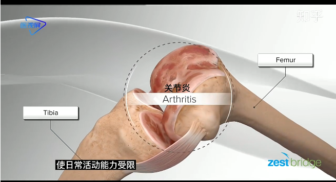 人工膝蓋置換術(shù)3D動(dòng)畫示意圖