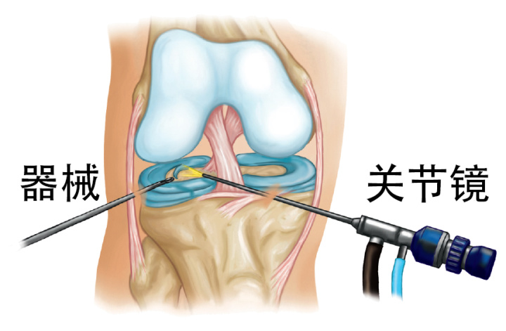 關(guān)節(jié)鏡手術(shù)的那些事