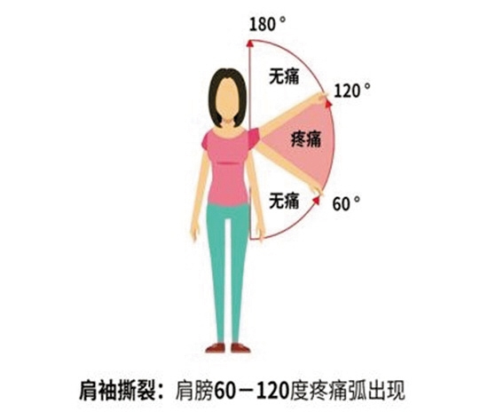 肩痛就是肩周炎？怎么分辨是不是肩周炎？