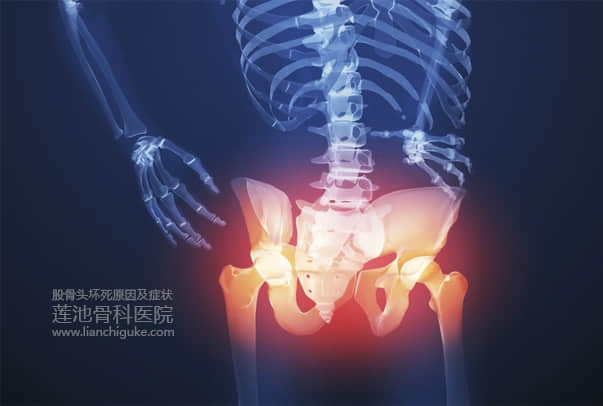 股骨頭壞死原因及癥狀