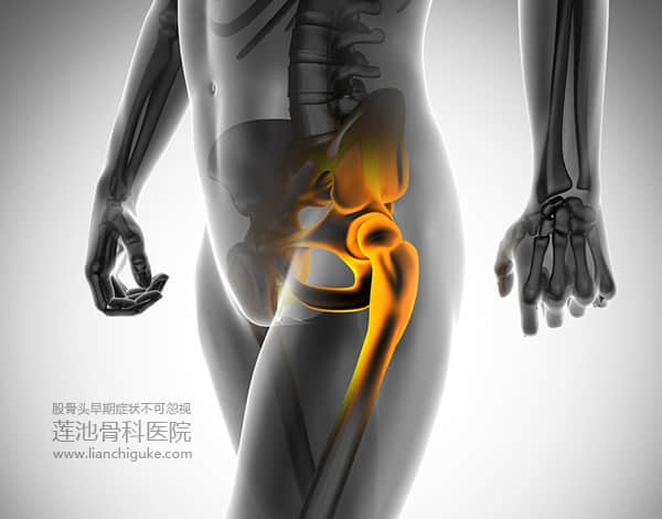 股骨頭早期癥狀不可忽視