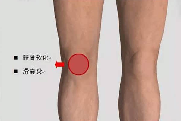 一分鐘搞懂你的“膝蓋痛”