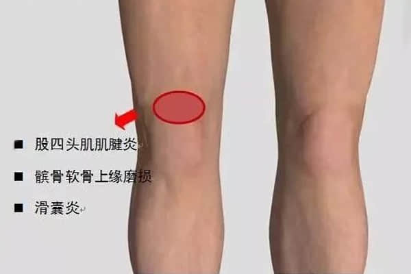 一分鐘搞懂你的“膝蓋痛”