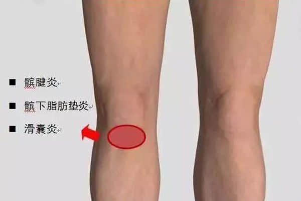 一分鐘搞懂你的“膝蓋痛”