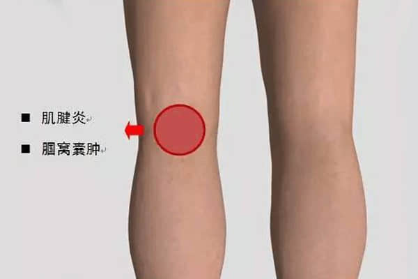 一分鐘搞懂你的“膝蓋痛”
