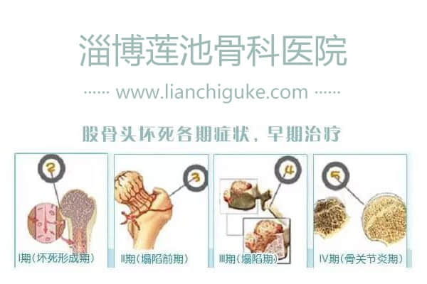 股骨頭壞死癥狀