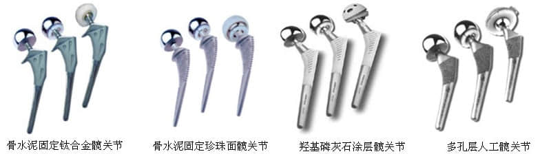 股骨頭壞死關(guān)節(jié)置換假體價(jià)格