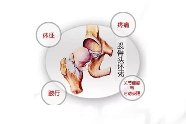 股骨頭壞死五大疑問，你真的都懂了么？