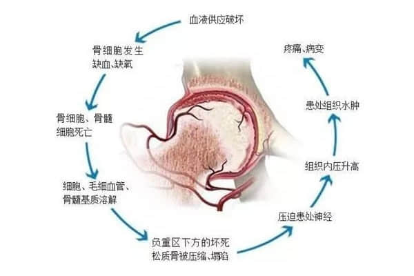 股骨頭壞死后股骨頭變形、塌陷怎么辦？