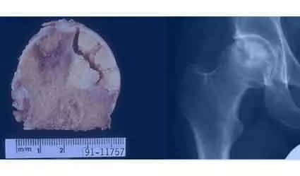 股骨頭壞死是怎樣一步步發(fā)展的？