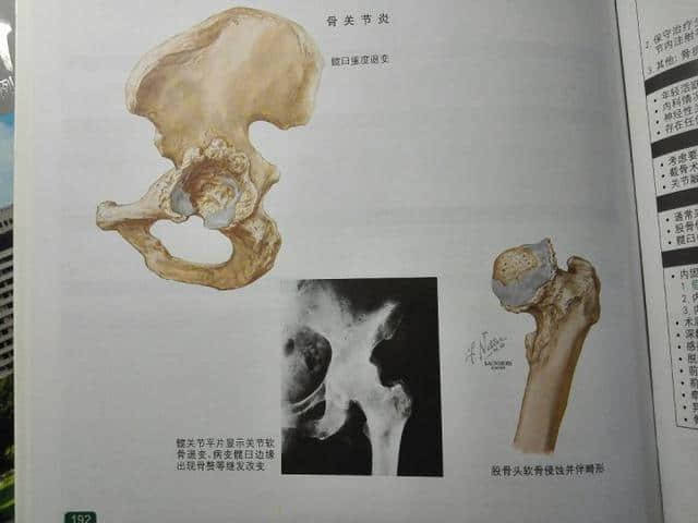 股骨頭壞死原因和康復(fù)