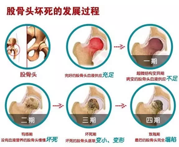 股骨頭壞死會(huì)造成患者哪里疼痛