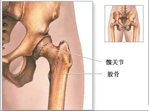 蓮池骨科醫(yī)院-股骨頭壞死患者，哪些情況下要做置換手術(shù)了？