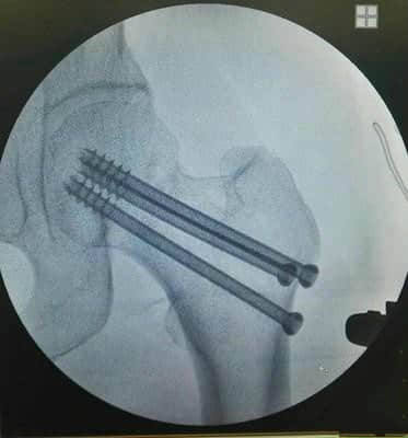 股骨頸骨折為什么被稱為“人生最后一次骨折”