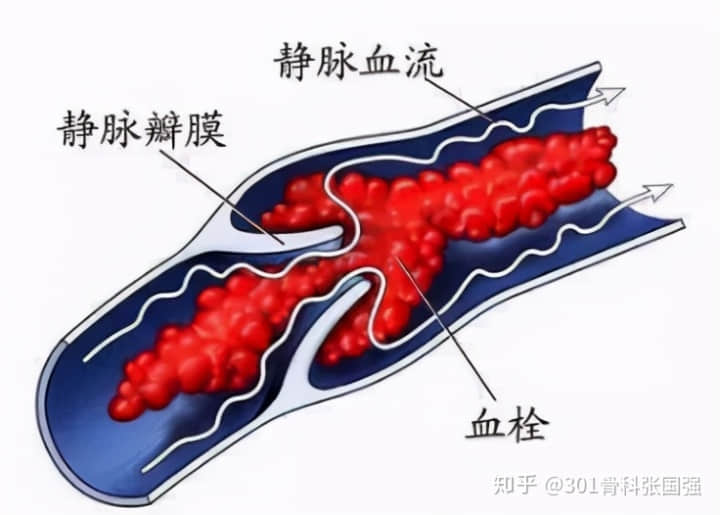 年齡「越大」，膝關(guān)節(jié)置換手術(shù)風(fēng)險(xiǎn)「越高」嗎？