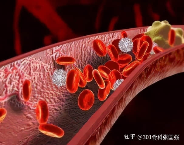 年齡「越大」，膝關(guān)節(jié)置換手術(shù)風(fēng)險(xiǎn)「越高」嗎？