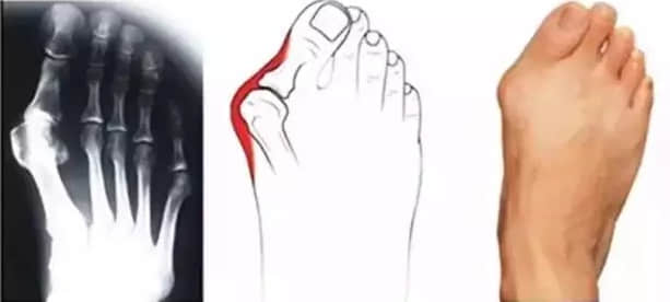 關(guān)于拇外翻，讀懂這一篇就夠了