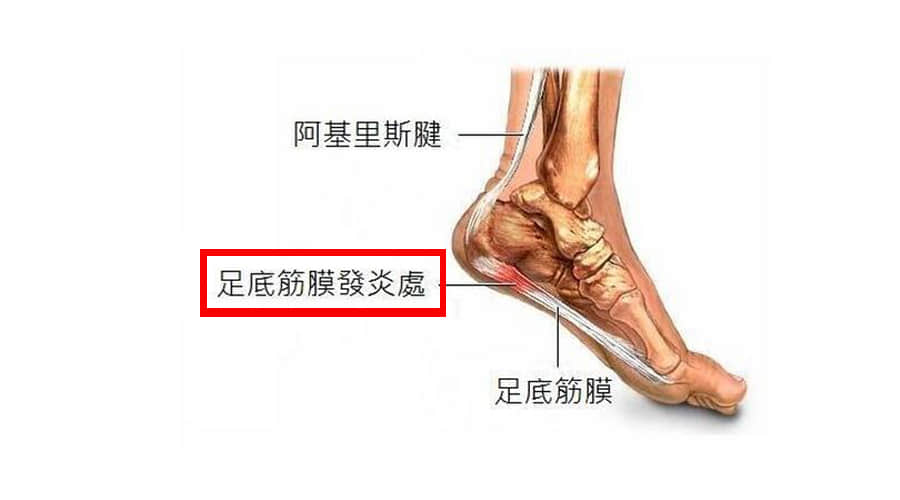 哪些人或者哪些習慣 容易患足底筋膜炎？