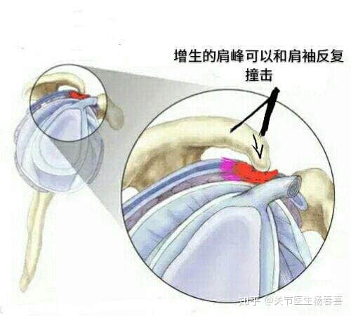 肩峰撞擊綜合癥必須做手術(shù)嗎?