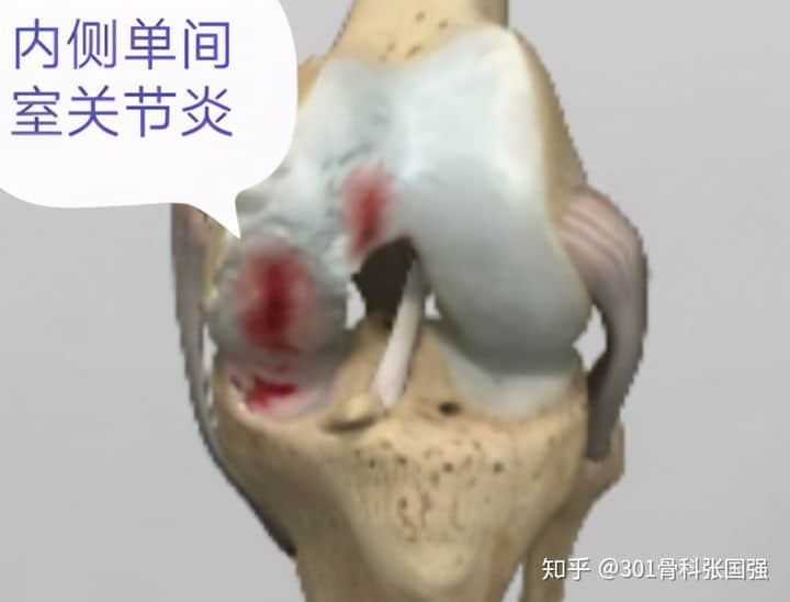 只有膝關節(jié)內側疼也要換膝關節(jié)嗎？