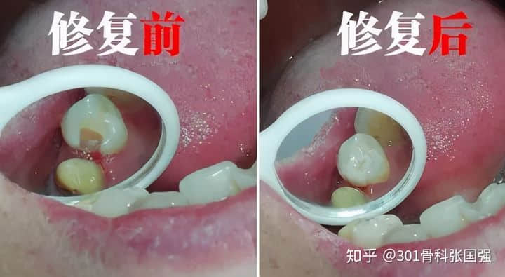 只有膝關節(jié)內側疼也要換膝關節(jié)嗎？