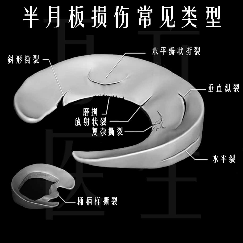 上下樓梯膝蓋疼痛是什么原因
