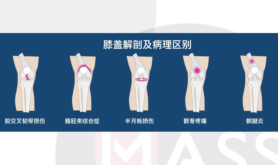 如何分辨半月板損傷還是韌帶損傷？