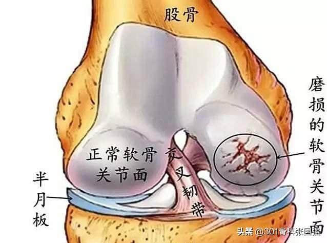 膝關(guān)節(jié)軟骨磨損了能復(fù)原嗎？