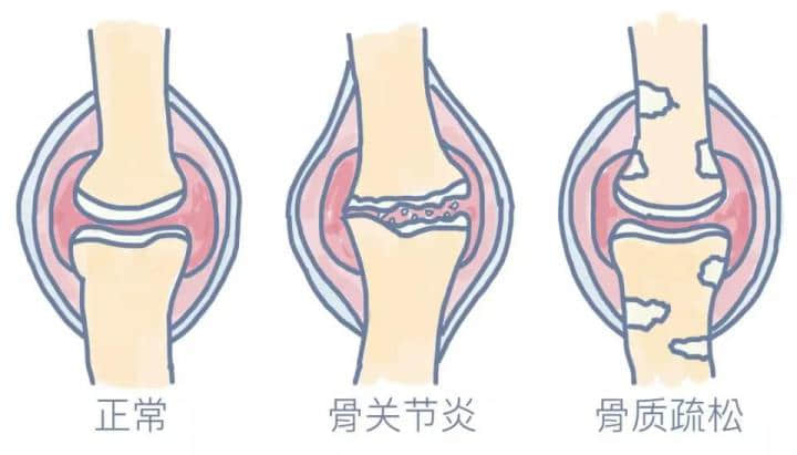 膝骨關(guān)節(jié)炎是一種老年常見病，多見于50歲以上人群，是引起老年人疼痛和殘疾的主要原因，常導(dǎo)致患者生活質(zhì)量下降。在門診中，我們經(jīng)常會碰到這樣的患者或家屬，他們關(guān)切的問道：這個(gè)病能根治嗎，需要怎么治療？可以看出很多人對這一疾病還缺乏基本的認(rèn)知。

下面，我們來全面認(rèn)識下什么是膝骨關(guān)節(jié)炎。

★膝骨關(guān)節(jié)炎的概念★

膝骨關(guān)節(jié)炎還有一種說法叫膝關(guān)節(jié)退行性變，通俗點(diǎn)說就是關(guān)節(jié)老化了，這種老化的根源是關(guān)節(jié)軟骨的老化。

正常膝關(guān)節(jié)表面都有一層厚度約為3-5mm的軟骨，關(guān)節(jié)軟骨非常光滑，起到潤滑、緩沖應(yīng)力的作用。

隨著年齡增長軟骨會逐漸變薄，如果再伴有這些因素，比如：外傷，關(guān)節(jié)受力異常，韌帶或半月板損傷，先天發(fā)育不良，體重過大等，就會加速軟骨的磨損老化。

關(guān)節(jié)軟骨結(jié)構(gòu)的完整性非常重要，一旦損傷，會導(dǎo)致關(guān)節(jié)腫脹和疼痛，加速破壞，發(fā)展成骨關(guān)節(jié)炎。

由于關(guān)節(jié)軟骨中沒有血管，其營養(yǎng)物質(zhì)依靠關(guān)節(jié)液供應(yīng)，其本身也不含可以分化再生的細(xì)胞，一旦損傷后很難自我修復(fù)或再生。

雖然近幾年來對于軟骨修復(fù)和軟骨再生的研究有了一些成果，但現(xiàn)階段來看，對于老年骨關(guān)節(jié)炎的軟骨再生是不可能的。








圖：左側(cè)為健康的膝關(guān)節(jié)（軟骨完整），右側(cè)為骨關(guān)節(jié)炎的膝關(guān)節(jié)炎（軟骨破壞）

所以說膝骨關(guān)節(jié)炎是不可能治愈的，但是對于不同嚴(yán)重程度的膝骨關(guān)節(jié)炎，通過正確有效的治療，可以緩解或消除疼痛，延緩關(guān)節(jié)老化速度，改善或恢復(fù)關(guān)節(jié)功能，提高患者的生活質(zhì)量，實(shí)現(xiàn)臨床治愈。

那么該如何正確有效的治療呢？

★膝骨關(guān)節(jié)炎的治療★

膝骨關(guān)節(jié)炎可根據(jù)疼痛及對日?；顒拥挠绊懗潭确譃槌跗凇⒃缙?、中期和晚期，針對不同分期，有不同的治療策略。








中華醫(yī)學(xué)會《骨關(guān)節(jié)炎診療指南》2018 年版，針對不同分期的膝骨關(guān)節(jié)炎提出基礎(chǔ)治療、藥物治療、修復(fù)性治療和重建治療四層次的金字塔型的階梯治療策略。

基礎(chǔ)治療
基礎(chǔ)治療包括：健康教育，運(yùn)動治療，物理治療和行為支持治療。對癥狀較輕的初期患者這是首選的治療方式。強(qiáng)調(diào)改變生活及工作方式的重要性，使患者樹立正確的治療目標(biāo)，減輕疼痛、改善和維持關(guān)節(jié)功能，延緩疾病進(jìn)展。

藥物治療
按藥物使用途徑分為外用藥物、口服藥物、關(guān)節(jié)腔內(nèi)注射藥物等。

口服藥物：在使用口服藥物前，建議先選擇局部外用藥物，尤其是老年人，可使用各種NSAIDs類藥物的凝膠貼膏、乳膠劑、膏劑、貼劑等，如氟比洛芬凝膠貼膏、扶他林乳膏等?？诜幬镏凶畛Ｓ玫氖荖SAIDs類鎮(zhèn)痛藥，但要注意NSAIDs類藥物過量使用并不能增強(qiáng)療效、可能會增加毒副反應(yīng)。

關(guān)節(jié)腔注射藥物：對早中期可緩解疼痛，改善關(guān)節(jié)功能，但該方法是侵入性治療，可能會增加感染的風(fēng)險(xiǎn)，必須嚴(yán)格無菌操作及規(guī)范操作，而且最新的國際指南并不推薦關(guān)節(jié)腔注射。

手術(shù)治療
修復(fù)性治療包括：關(guān)節(jié)鏡手術(shù)，關(guān)節(jié)軟骨修復(fù)術(shù)及生物治療，膝關(guān)節(jié)周圍截骨術(shù)。

關(guān)節(jié)鏡清理：主要針對伴有“膝關(guān)節(jié)卡頓”或半月板撕裂等癥狀的患者，通過關(guān)節(jié)鏡下摘除游離體、清理半月板碎片及增生的滑膜等，能減輕部分早中期患者的癥狀，但有研究認(rèn)為其遠(yuǎn)期療效與保守治療相當(dāng)，最新的國際指南也不推薦關(guān)節(jié)鏡手術(shù)作為癥狀性骨關(guān)節(jié)炎患者的治療手段。

關(guān)節(jié)軟骨修復(fù)術(shù)及生物治療:療效尚需進(jìn)一步研究探索。

膝關(guān)節(jié)周圍截骨術(shù)：是經(jīng)典的保膝治療手段，最常用的是脛骨高位截骨術(shù)（HTO）。該方法通過改變力線來改變關(guān)節(jié)面的接觸面，就像是一顆小樹長歪了，我們通過外力把它變直。該方法可以有效緩解甚至消除疼痛，大部分患者可不需再行關(guān)節(jié)置換。該方法適合青中年活動量大、力線不佳的患者。


重建性手術(shù)：主要是人工關(guān)節(jié)置換術(shù)，包括膝關(guān)節(jié)部分置換術(shù)（單髁置換術(shù)）和全膝關(guān)節(jié)置換術(shù)。


單髁置換術(shù)：適用于當(dāng)膝關(guān)節(jié)的軟骨只有一個(gè)地方受累，而且關(guān)節(jié)韌帶功能完好的情況下。這是一種微創(chuàng)手術(shù)，該技術(shù)能盡可能保留正常的關(guān)節(jié)結(jié)構(gòu)，具有創(chuàng)傷小，恢復(fù)快，術(shù)后關(guān)節(jié)自我感覺好等優(yōu)點(diǎn)，十年優(yōu)良率在95%左右。但是當(dāng)關(guān)節(jié)軟骨多個(gè)部分或全部都受累時(shí)，單髁置換就不能解決問題了。這時(shí)需要全膝關(guān)節(jié)置換。


全膝關(guān)節(jié)置換術(shù)：是針對終末期骨關(guān)節(jié)炎成熟且有效的治療方法，尤其是伴有各種嚴(yán)重畸形時(shí)，能非常有效的解除患者病痛，極大提高患者生活質(zhì)量。術(shù)后絕大多數(shù)患者遠(yuǎn)期效果滿意，15-20年假體生存率可達(dá)90%。

結(jié)語
隨著人類壽命的延長，人口老齡化，骨關(guān)節(jié)炎的發(fā)生率逐年增加，嚴(yán)重影響人們的生活質(zhì)量和健康，給社會造成巨大的經(jīng)濟(jì)負(fù)擔(dān)和壓力。所以，從年輕時(shí)我們就該引起重視，預(yù)防骨關(guān)節(jié)炎的發(fā)生。在出現(xiàn)癥狀的骨關(guān)節(jié)炎初期、早期，要正確認(rèn)識，通過積極的基礎(chǔ)治療和藥物治療，盡可能減緩病情進(jìn)展。

當(dāng)中晚期時(shí)，要根據(jù)病情、年齡、社會活動的不同層次，以及關(guān)節(jié)間室累及情況，選擇合適的手術(shù)方案。特別是當(dāng)疼痛癥狀較重，嚴(yán)重影響生活質(zhì)量時(shí)，應(yīng)盡早進(jìn)行手術(shù)治療，而不是往后拖。