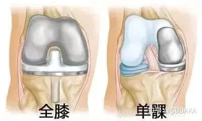 膝關(guān)節(jié)還能換半邊？UKA單髁置換是什么