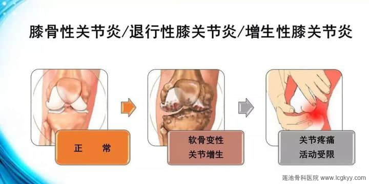 膝骨性關(guān)節(jié)炎，“保膝”“換膝”如何選？