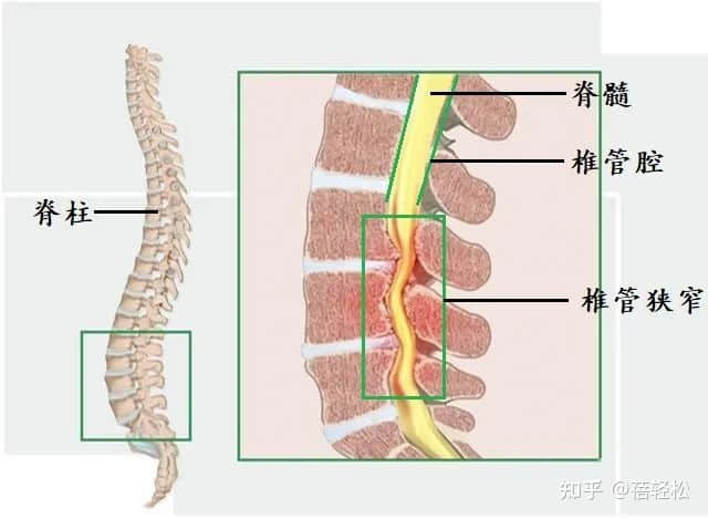 椎管狹窄是什么意思？嚴(yán)重嗎?
