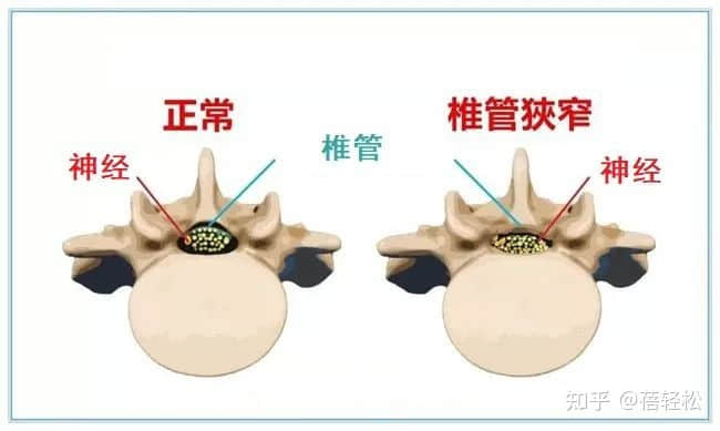 椎管狹窄是什么意思？嚴(yán)重嗎?
