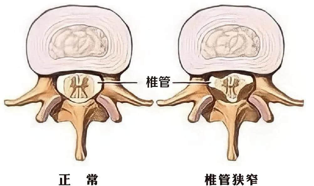 腰椎椎管狹窄癥？試試UBE技術(shù)！