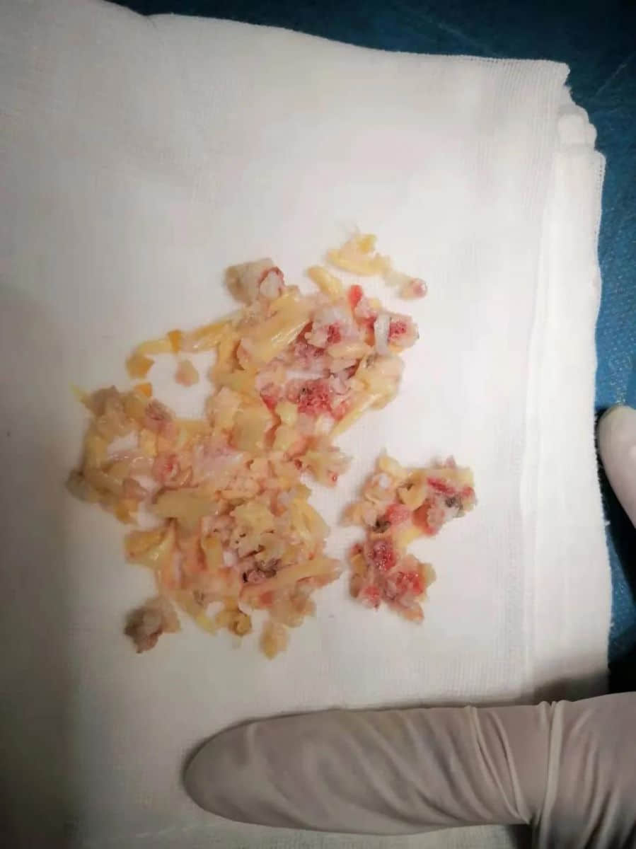 腰椎椎管狹窄癥？試試UBE技術(shù)！