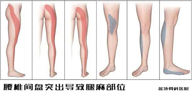 經(jīng)常腿麻你有可能已經(jīng)腰椎間盤(pán)突出