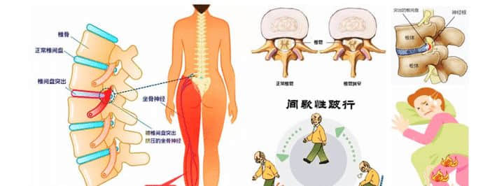 老年腰突癥與年輕患者有什么不同？哪些方法更適合？